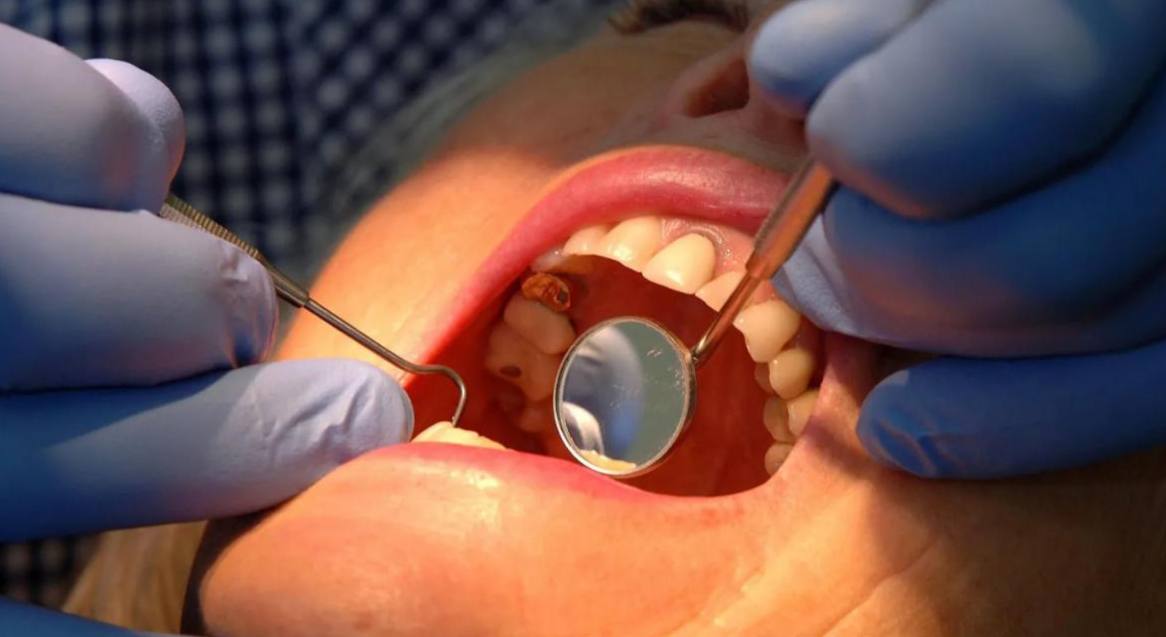 Кариес победили учёные создали гель из слюны который сам восстанавливает эмаль Достаточно просто нанести гель на зубы и эмаль регенерируется БЕЗ пломбы боли и дорогих походов к стоматологу Первые тесты прошли успешно впереди массовые испытания Как думаете это будет применяться Подписаться Прислать новость