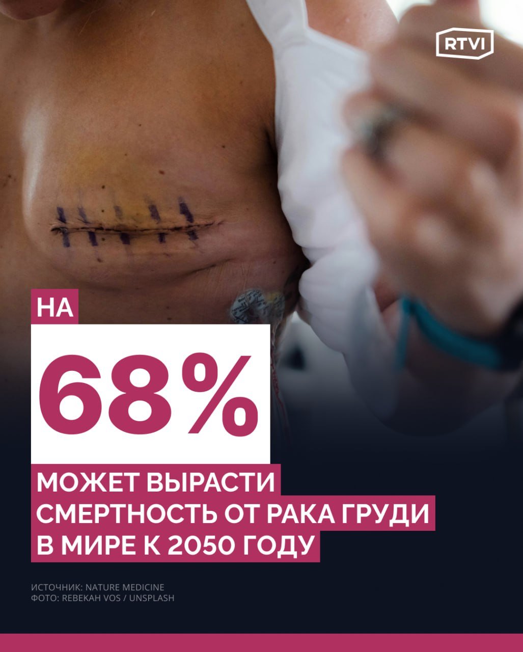 Заболеваемость раком груди вырастет на 38% к 2050 году, а смертность — на 68%, прогнозируют ученые  Группа международных специалистов изучила данные по 185 странам. Согласно результатам, опубликованным в журнале Nature Medicine, в 2022 году в мире было зарегистрировано 2,3 млн случаев рака груди и 670 тыс. смертей от этого заболевания. Ученые подсчитали, что эти показатели увеличились на 1-5% в половине из исследуемых стран.  Согласно прогнозу, к 2050 году число новых случаев заболевания раком молочной железы может достичь 3,2 млн, а смертность — 1,1 млн