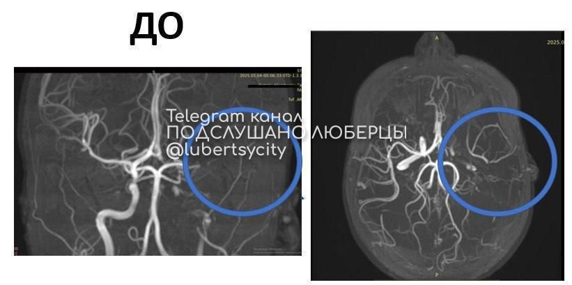В Подмосковье спасли 10-летнюю девочку от инсульта Школьнице стало плохо в ванной: отказали правая рука и нога, перекосилось лицо, нарушилась речь. Мать срочно вызвала скорую — девочку доставили в Центр Рошаля через два часа после первых симптомов. МРТ показало тромб в сонной артерии и обширный инсульт. Врачи провели тромболизис и восстановили кровоток. Это спасло ребёнка от инвалидности и смерти. Сейчас девочка проходит восстановление в неврологии. Подслушано Люберцы