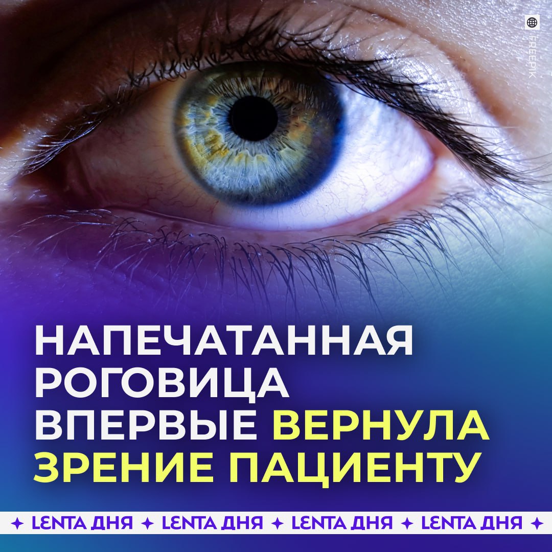 Пациенту впервые вернули зрение с помощью роговицы напечатанной на 3D принтере Хирурги Израиля провели уникальную операцию пациенту который долгие годы жил в полной слепоте Он снова начал видеть благодаря искусственной роговице созданной в биопринтере на основе клеток донора Новый имплант полностью повторил структуру естественной ткани и прижился без осложнений При этом из клеток одной роговицы можно изготовить сотни таких образцов что может решить проблему дефицита донорских материалов   развитию медицины Подпишись на Ленту дня MAX ТГ Участвуй в розыгрыше