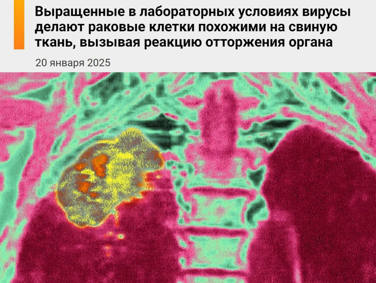 Учёные нашли новый способ борьбы с раком, при котором организм самостоятельно уничтожает злокачественные клетки   Подробности:  Обычно человеческий организм отторгает чужеродные ткани и органы;  На этом принципе исследователи решили «замаскировать» опухоли, сделав их похожими на ткани свиньи, чтобы спровоцировать иммунный ответ;  Для этого был использован безопасный для человека вирус Ньюкасла, который модифицировали так, чтобы он добавлял свиные сахара на поверхность раковых клеток;  Эта «маскировка» позволила иммунной системе распознать опухоли как чужеродные объекты и начать их уничтожение;  Метод стимулирует иммунную систему бороться с опухолью, заставляя организм самостоятельно устранять раковые клетки;  Эффективность этого подхода проверили на пациентах с разными видами трудноизлечимого рака, такими как рак печени, пищевода, прямой кишки, яичников, лёгких, груди, кожи и шейки матки;  Результаты показали, что у некоторых пациентов опухоли уменьшились в размерах, а у других перестали расти;  Учёные планируют получить патент до конца года.