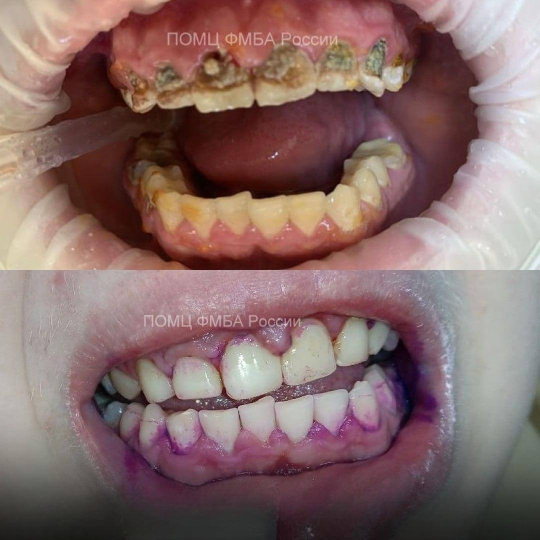 Энергетики чуть не оставили нижегородца без зубов 18 летний юноша несколько недель подряд без перерыва употреблял энергетические напитки Из за этого у него повысилась кислотность слюны а эмаль начала разрушаться Стоматологам ПОМЦ пришлось удалять все нервы на поврежденных зубах эмаль восстановили пломбами а налёт убрали профессиональной чисткой Подписаться на нас в MAX