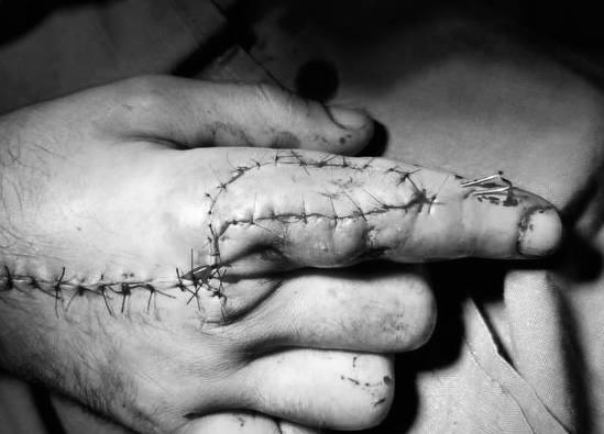 Это не персонаж сериала Уэнсдей а рука 32 летнего жителя подмосковного Красногорска который слишком поздно решил полечить рану полученную при сборе мебели Всего то расцарапал палец проволокой а в итоге чудом не лишился пальца В рану проникли бактерии возник гнилостно некротический сухожильный панариций да так это называется на медицинском языке еще немного и палец просто отвалился бы Сейчас к счастью уже все в порядке Фото Минздрава Московской области