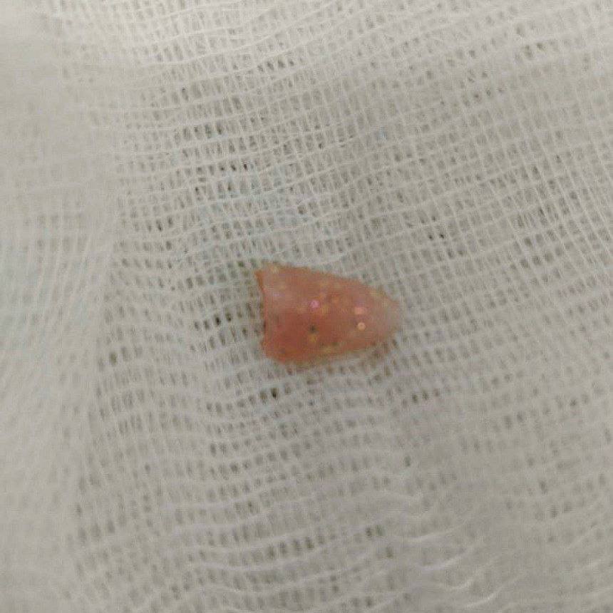 В Челябинске младенец чуть не задохнулся из за застрявшего в горле ногтя Десятимесячный малыш хрипел и задыхался просвет голосовой щели был почти полностью на 4 5 перекрыт инородным предметом Врачи Челябинской областной больницы предположили что это кость Операция ригидная бронхоскопия прошла в экстренном режиме достать предмет обычным эндоскопом не удалось Все закончилось удачно а находка шокировала даже опытных врачей извлечённым предметом оказался наращенный ноготь Сейчас малыш уже в обычной палате под наблюдением врачей Подписаться