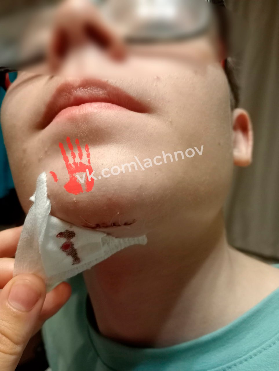 Подросток разбил лицо из-за вешалки в термах Voda Мама мальчика винит во всем руководство бассейна, ведь конструкция не была закреплена . Но администрация терм признавать вину отказывается. Школьник упал 12 июня. Как рассказала подписчика АЧН, ее сын отдыхал с тетей, братом и сестрой. В какой-то момент мальчик вышел из бассейна и стал искать шлепки. Но из-за плохого зрения сразу их не разглядел. “Он наклонился, чтобы найти свои тапочки. Но поскользнулся и оперся на вешалку для полотенец, чтобы не упасть. Вешалка оказалась не прикреплена к полу и упала вместе с ним. Ребенок ударился подбородком о кафель”, – рассказывает челябинка Дария. Итог - разбитый подбородок, 4 шва и сломанный зуб. У тети при виде лужи крови случилась паника. По словам Дарии, в бассейне вызывать скорую им никто не стал. А в травмпункте врачи сказали, что мальчик легко мог сломать челюсть. Женщина связалась с администрацией водного комплекса. Но там, по ее словам, признавать вину отказались, утверждая, что ребенок был без тапочек. При этом деньги вернули и даже предложили бесплатное посещение. Но челябинку такие уступки не устраивают. “На вопрос: «Если б он челюсть сломал, тоже бы: вот вам возврат и бесплатное посещение?» Ответа дать не могут, утверждая, что вина исключительно ребенка и меня, раз меня не было в заведении с ним. Камеры показывать с происшествием сотрудники отказываются, ссылаясь на правило заведения: видео с камеры гостям не показывать”, – возмущается Дария. Женщина уверена, что вешалки и сушилки в подобных местах должны быть закреплены. Поэтому написала заявление в полицию. Пострадавшему мальчику выдали направление на судмедэкспертизу, чтобы определить степень тяжести травмы.