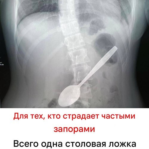 В Подмосковье девочка подавилась яблоком и проглотила столовую ложку — врачи доставали её час А что ещё случилось?