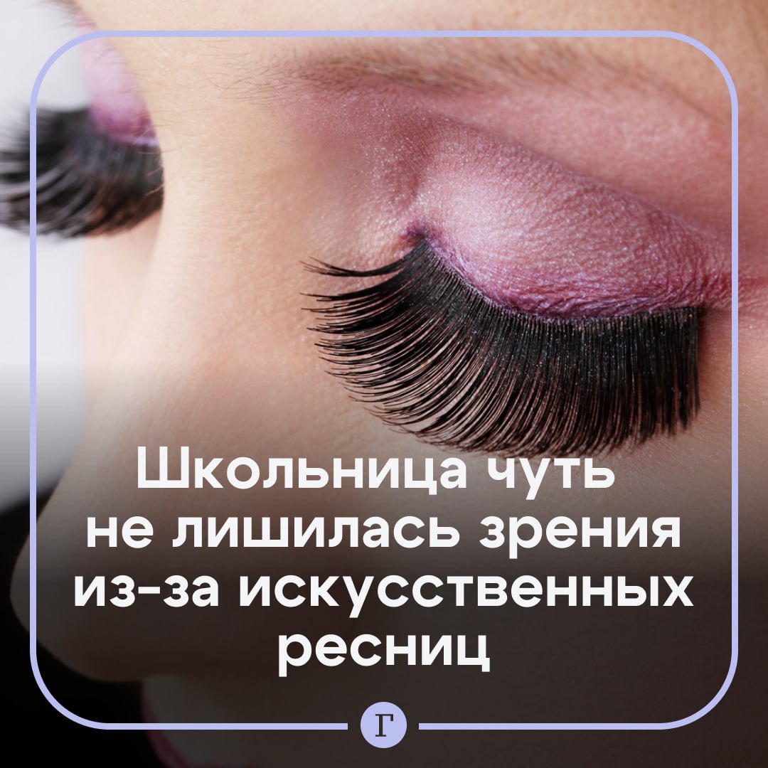 Врачи спасли глаз 14-летней девочки, которая приклеивала ресницы обувным клеем. Школьница из Калининградской области решила поэкспериментировать с внешностью с помощью «Момента». В итоге верхние и нижние веки склеились между собой, возникли сильная боль, отек, а глаз перестал открываться. Мать девочки вызвала скорую помощь. Пострадавшую доставили в медучреждение с подозрением на химический ожог. Оказалось, что ей повезло — клей не попал на слизистую, но веки и накладные ресницы сильно склеились. Врачи под местной анестезией аккуратно разделили их, частично срезав, в том числе, и натуральные ресницы девочки ножницами. Медики дали рекомендации по лечению и объяснили необходимость использования специальных клеев и растворов для искусственных ресниц, сообщили в областном Минздраве.
