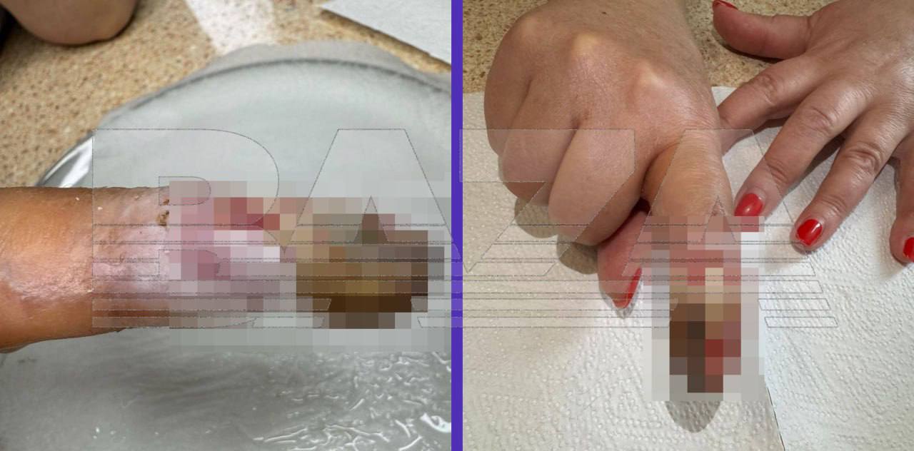 Жительница Подмосковья лишилась фаланги пальца после операции в частной клинике МАММА в Одинцово По словам пострадавшей хирург повредил сухожилия и неправильно ввёл анестезию что привело к некрозу Медцентр отказался признавать вину и компенсировать ущерб mosreg поток