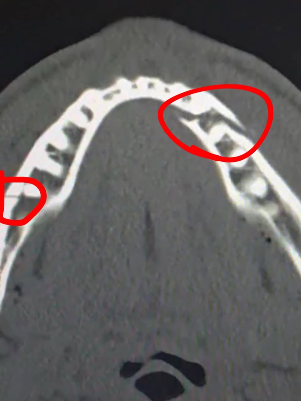Джейк Пол получил двойной перелом челюсти в бою с Джошуа Блогер Джейк Пол сообщил что сломал челюсть в боксерском поединке против бывшего чемпиона мира в супертяжелом весе Энтони Джошуа Бой прошел в Майами и завершился нокаутом Пола в шестом раунде По ходу поединка блогер дважды побывал в нокдаунах Кажется у меня сломана челюсть Да она точно сломана сказал Пол во время интервью на ринге после боя Бой был крутым мне понравилось Я еще вернусь и хочу стать чемпионом мира Пол не участвовал в послематчевой пресс конференции так как отправился в больницу На видео которое он опубликовал в Instagram принадлежит Meta компания признана экстремистской и запрещена в России видно что задние зубы Пола смещены относительно передних Позднее он выложил рентгеновский снимок травмы Двойной перелом челюсти Дайте мне Канело Сауля Альвареса РБК через 10 дней подписал свой пост Пол Также он выложил ролик с больничной койки соцсети Джейка Пола Подписаться на РБК Спорт