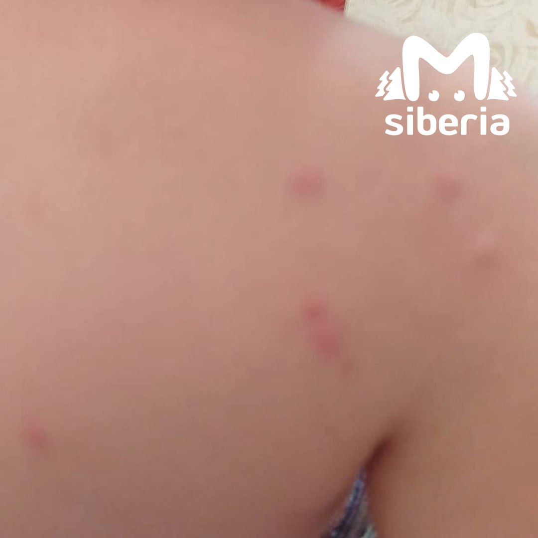 Отдыхающие покрылись сыпью после купания в озере в Омской области. Мальчик с тётей плескались в Линёво, а на следующий день покрылись прыщами. Говорят, это может быть церкариоз или «зуд купальщиков» — заболевание, которое вызывают личинки плоских червей. Они паразитируют на водоплавающих птицах. Неприятная штука, но проходит быстро.