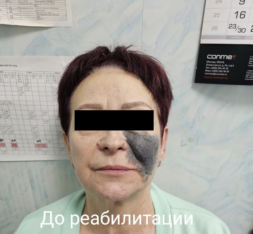 В Ставрополе успешно прооперировали пациентку с гигантской родинкой на лице В отделение челюстно-лицевой хирургии ГКБ СМП краевого центра поступила 68-летняя женщина. В последние месяцы невус начал вызывать постоянный зуд, боль, а также заметно вырос. После комплексного обследования хирурги оценили риски и приняли решение об операции. Её проводил завотделением Дмитрий Христофорандо. Процесс включал иссечение невуса и реконструкцию дефекта из других лоскутов кожи После операции лицо пациентки успешно зажило. Горожанка поделилась своей историей, чтобы помочь другим, столкнувшимся с подобной проблемой. Врачи напоминают: при наличии крупных невусов, особенно с изменениями, необходимо незамедлительно обращаться к специалистам.
