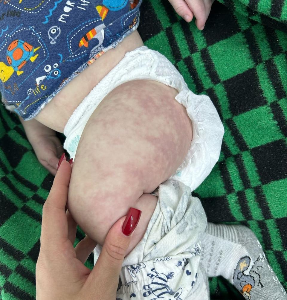 Прокуратура признала законным возбуждение уголовного дела по факту гибели семимесячного ребенка в Приморском крае, которому, по мнению родителей, не оказали своевременную помощь.  Следствие установило, что в феврале 2025 года мальчик 2024 года рождения поступил в медико-санитарную часть Фокино с общим ухудшением состояния здоровья. Его осмотрели и направили в Находкинскую городскую больницу. Но мальчику становилось только хуже, и тогда его решили госпитализировать во Владивосток. По пути в краевой центр состояние ухудшилось до критического, и врачи экстренно доставили малыша в Фокино, где он умер.  Следствие возбудило уголовное дело по статье «Причинение смерти по неосторожности вследствие ненадлежащего исполнения лицом своих профессиональных обязанностей». Также ведомство отдельно проверит качество оказания медицинской помощи малолетнему со стороны всех медицинских учреждений.   Подписаться