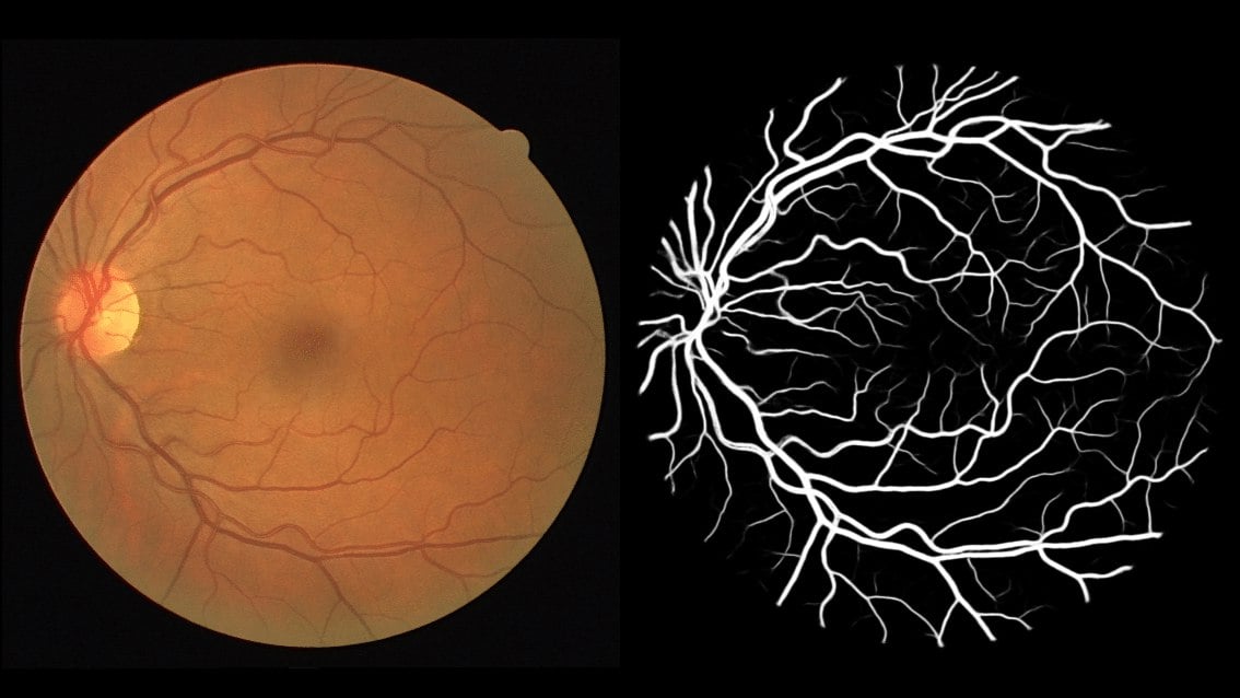 Искусственный интеллект ускорит постановку диагноза по снимку сетчатки глаза  Исследование представлено в журнале Pattern Recognition Letters. При помощи прибора под названием фундус-камера офтальмологи делают снимки глазного дна, на которых видна сетчатка и сеть кровеносных сосудов в ней. Врач изучает такое изображение и вручную сегментирует его в специальной компьютерной программе, выделяя сосуды разной длины, ширины и извилистости. Особенности сосудистой сети сетчатки могут указывать на наличие у пациента диабетической ретинопатии и других глазных или сердечно-сосудистых заболеваний, включая атеросклероз. Однако сегментация изображения вручную очень сложна, требует много времени и подвержена ошибкам.  И вот ученым удалось автоматизировать эту сложную задачу, причем новое решение на базе ИИ не просто сэкономит время врачей, но и, возможно, устранит некоторые человеческие ошибки.