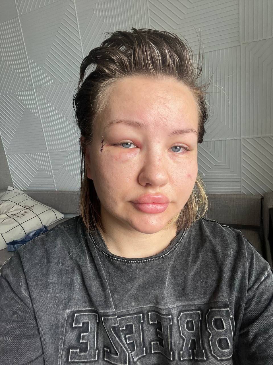 Бывший парень избил женщину, а полиция «ушла в отпуск» Во Владивостоке женщина обратилась за помощью после того, как её жестоко избил бывший парень, однако столкнулась с бездействием правоохранительных органов. 12 июня около 00:40 она находилась по адресу Красного Знамени, 133/3, когда мужчина пришёл за своими вещами. Он попросил друга помочь ему, так как думал, что женщина не откроет дверь. Открыв входную дверь, она увидела его друга — с которым ранее была знакома — а затем из-за спины появился её бывший парень. Он зашёл в квартиру, закрыл дверь и начал избивать её кулаками по голове. Женщина кричала и звала на помощь, но дверь была закрыта, и человек снаружи не мог открыть её. Она периодически теряла сознание, а мужчина продолжал бить её по голове. В итоге она оказалась вся в крови, с разбитым лицом и тремя швами. Он же заявил: «можешь даже написать заявление в полицию — мне всё равно, я заплачу штраф 5000 рублей и мне ничего не будет». После этого он направился к выходу, а когда друг бывшего парня увидел женщину окровавленной, схватил мужчину и выгнал из квартиры. Друг вместе со своей девушкой оказали пострадавшей первую помощь. Женщина вызвала скорую и полицию. Медики приехали через 15–20 минут и отвезли её в отделение для оказания помощи — у неё была рваная рана на лице. Однако полиция так и не приехала ни ночью, ни на следующий день. Женщина самостоятельно обратилась в отделение полиции. Там ей сказали ждать — потому что её участковый в отпуске. Уже прошло четыре дня, а ей до сих пор никто не звонил: ни свидетели, ни соседи не опрошены; также ей не выдали направление на снятие побоев. В больнице врач посоветовал самой пройти процедуру фиксации побоев. Пострадавшая требует реакции и справедливости за случившееся. Источник: ; фото 18+