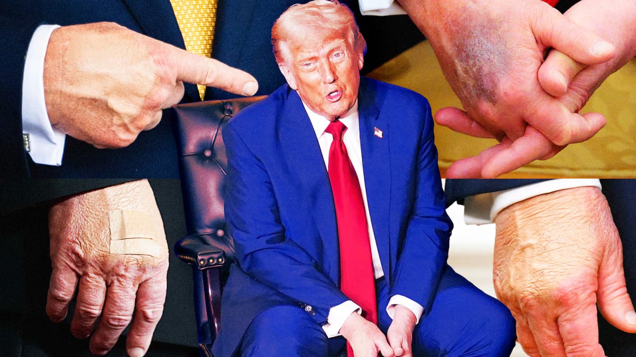 Трамп на фоне беспокойств о состоянии его здоровья признал что наносит макияж на руки У меня есть макияж который знаете легко наносится это занимает около 10 секунд заявил Трамп газете Wall Street Journal комментируя использование тональных средств на тыльной стороне ладони Трамп рассказал что ежедневно принимает большое количество аспирина ради разжижения крови дозировка превышает объем рекомендованной ему врачами в результате чего на его теле легко появляются синяки Они врачи ред говорят что аспирин разжижает кровь и я не хочу чтобы густая кровь текла через мое сердце Я хочу чтобы через мое сердце текла хорошая жидкая кровь Это имеет смысл Я немного суеверен отметил он объясняя отказ он снижения дозировки Однако Трамп отрицает что засыпал на публичных мероприятиях объяснив это морганием или просто закрыванием глаз для отдыха Американский лидер признал что ему бывает сложно расслышать слова когда много людей разговаривают