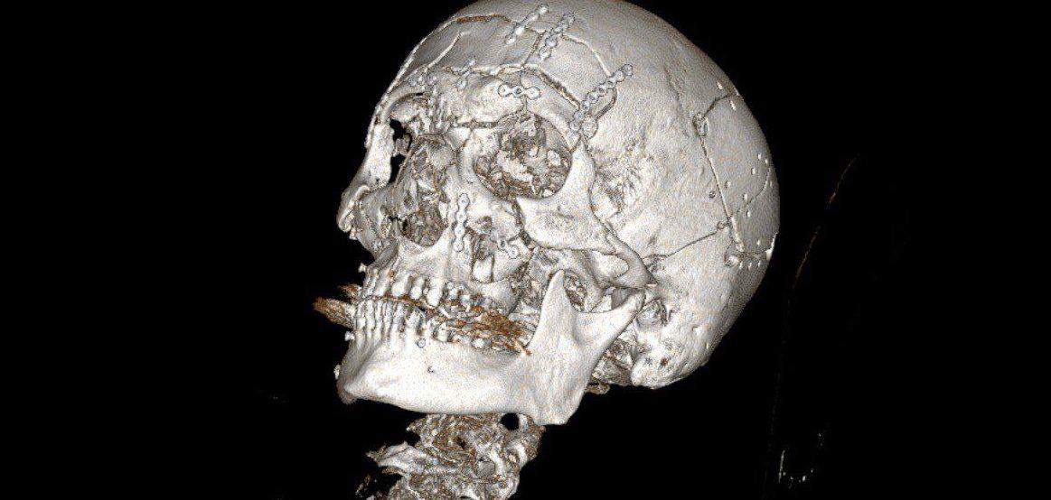 В Жуковской больнице хирурги провели успешную операцию по реконструкции лица 44 летнему пациенту получившему тяжёлые травмы в аварии на снегоходе За семь часов врачи восстановили из множества осколков кости лба челюсти и глазницы зафиксировав их титановыми пластинами Пострадавшему предстоит длительный период реабилитации mosreg поток