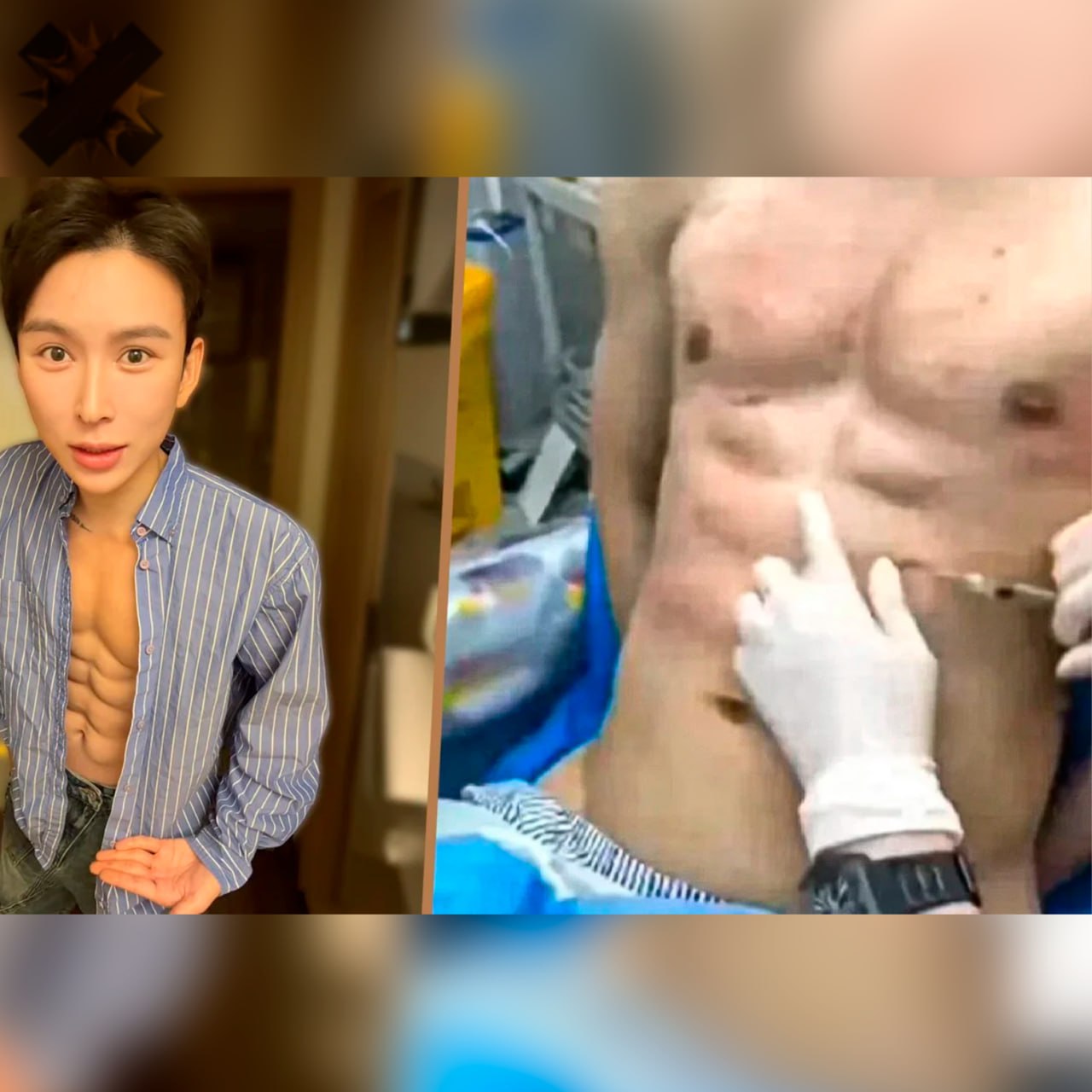 Китаец сделал себе искусственный пресс за 45 млн Житель Китая вложил 45 млн 560 тыс в создание идеального пресса из 8 кубиков с помощью гиалуроновой кислоты и заявляет что стал первым в стране с таким результатом Он утверждает что 20 его тела это гиалуронка и планирует сделать ещё 10 тысяч инъекций уже выполнив около 40 задуманного Врачи предупреждают такие эксперименты могут закончиться некрозом кожи смещением филлеров и атрофией мышц китайская копия Руки базуки мне настолько же лень но денег нет а накачать самому не дешевле было НМШ