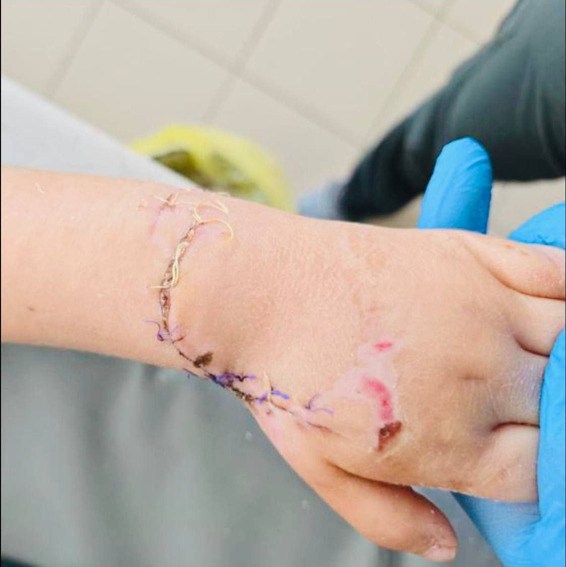 Приморские врачи спасли руку четырехлетней девочке которую в ноябре зажевало эскалатором в торговом центре в Фокино После нескольких операций и длительного лечения девочка вновь начала шевелить пальцами Впереди длительная реабилитация После травмы ребенка экстренно направили в Находкинскую горбольницу Из Находки малышку перевели в детское ортопедо травматологическое отделение Владивостокской клинической больницы 2 Состояние при поступлении было крайне тяжёлым синдром длительного сдавления левой кисти перелом лучевой кости со смещением обширные повреждения мягких тканей сосудов и нерва Пальцы кисти не двигались Под руководством заведующей отделением Евгении Кудиновой начался сложный этап лечения В течение месяца врачи проводили ежедневные перевязки хирургические обработки и последующую пластику раны Итог наших совместных усилий у девочки постепенно начали появляться движения в пальцах Сейчас ребёнок выписан домой в удовлетворительном состоянии Основной хирургический этап позади благодаря слаженной работе врачей Впереди важный период реабилитации Мы верим в полное восстановление рассказала заведующая детским травматологическим отделением ВКБ 2 Евгения Кудинова