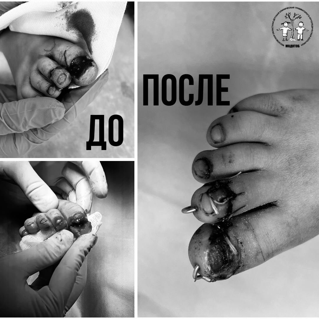 Бедные маленькие пальчики только такая реакция может быть на эти снимки Четырехлетняя девочка показывала сестре как ловко умеет залезать на шкаф и на нее упало зеркало Малышка получила переломы ногтевых фаланг ее доставили в Московскую областную детскую травматолого ортопедическую больницу Но в итоге судя по правому фото все обошлось Фото Минздрава Московской области