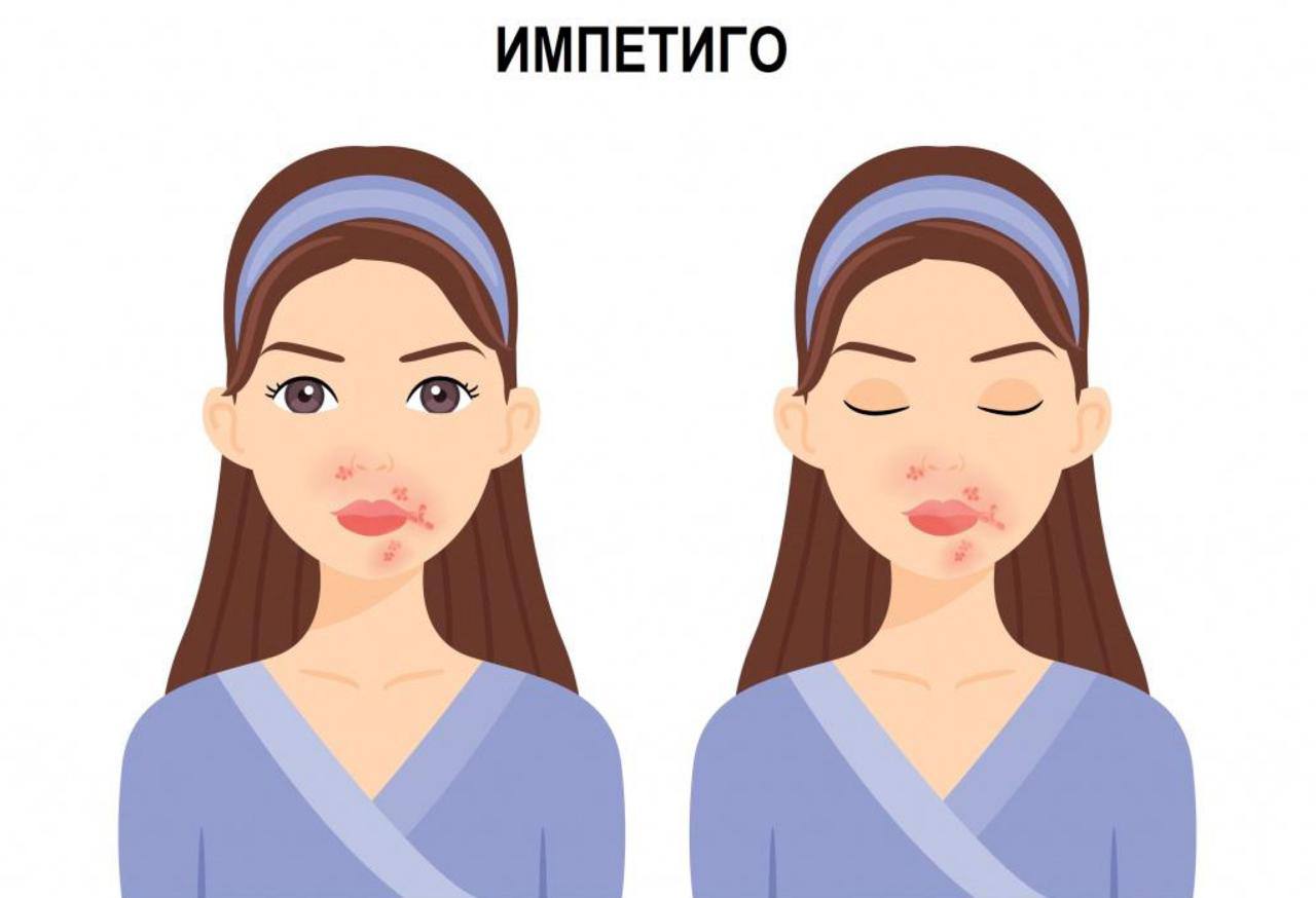 Целоваться с бородатыми мужчинами ОПАСНО для здоровья  Мероприятие может закончиться импетиго — это кожная инфекция от стрептококков и стафилококков. Бактерии отлично себя чувствуют в щетине, даже если она тщательно вымыта. Они легко попадают под кожу и вызывают воспаления, гной и прочие радости дерматологии.   Самое страшное: даже чистая борода не гарантирует безопасности.    Картотека Все по полочкам