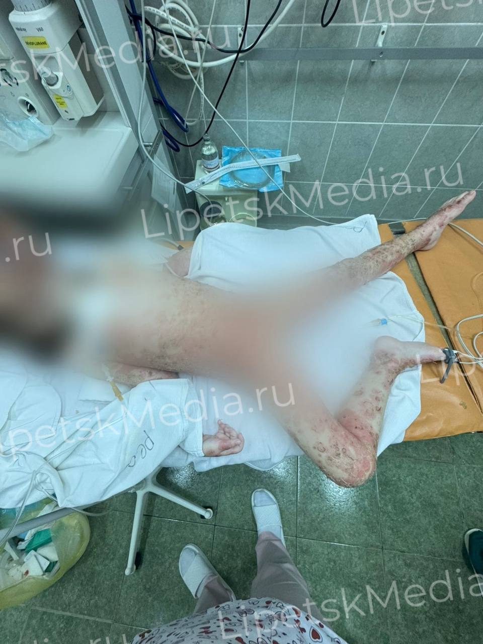 Борщевиком сожгла себе всё тело маленькая девочка   Четырёхлетняя малышка спряталась в заросли с ядовитым растением во время игры в прятки.   Химические ожоги заполнили 70% площади тела пациентки.   Её положили в реанимацию областной детской больницы. Здесь девочка прошла инфузорную терапию, коррекцию гемостаза, антибактериальную терапию и ежедневные перевязки с антисептиками.   Сейчас её состояние стабилизировано. Ребёнок находится в общей палате, сообщили медики.     – у наших врачей золотые руки    – здоровья малышке