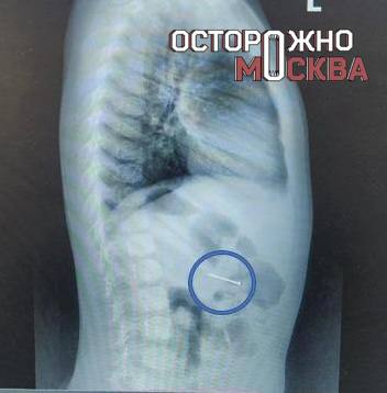 Ребёнок проглотил гвоздь в Подмосковье — потребовалась экстренная госпитализация Во время ремонта ребенок закашлял кровью. Его срочно доставили в клинический центр им. Л. М. Рошаля. К счастью, все обошлось благодаря оперативному вмешательству медиков.