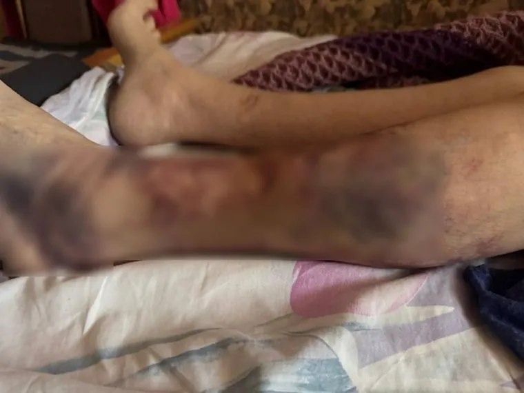 В Тюмени пенсионерку-инвалида зажало дверями автобуса и протащило по асфальту Тюменка пожаловалась, что ногу ее мамы-пенсионерки зажало дверями автобуса, а после протащило по асфальту. По ее словам, женщина является инвалидом и имеет тяжелую форму ревматоидного артрита, из-за чего медленно перебирает ногами. После произошедшего кондуктор сразу вызвала экстренные службы, после чего пенсионерку забрали в травмпункт. В медучреждении зафиксировали травмы и отправили домой, однако вечером у женщины поднялось давление, которое удалось стабилизировать лишь к ночи. Дочь уже зарегистрировала обращение в компанию перевозчика. ЧС Тюмень