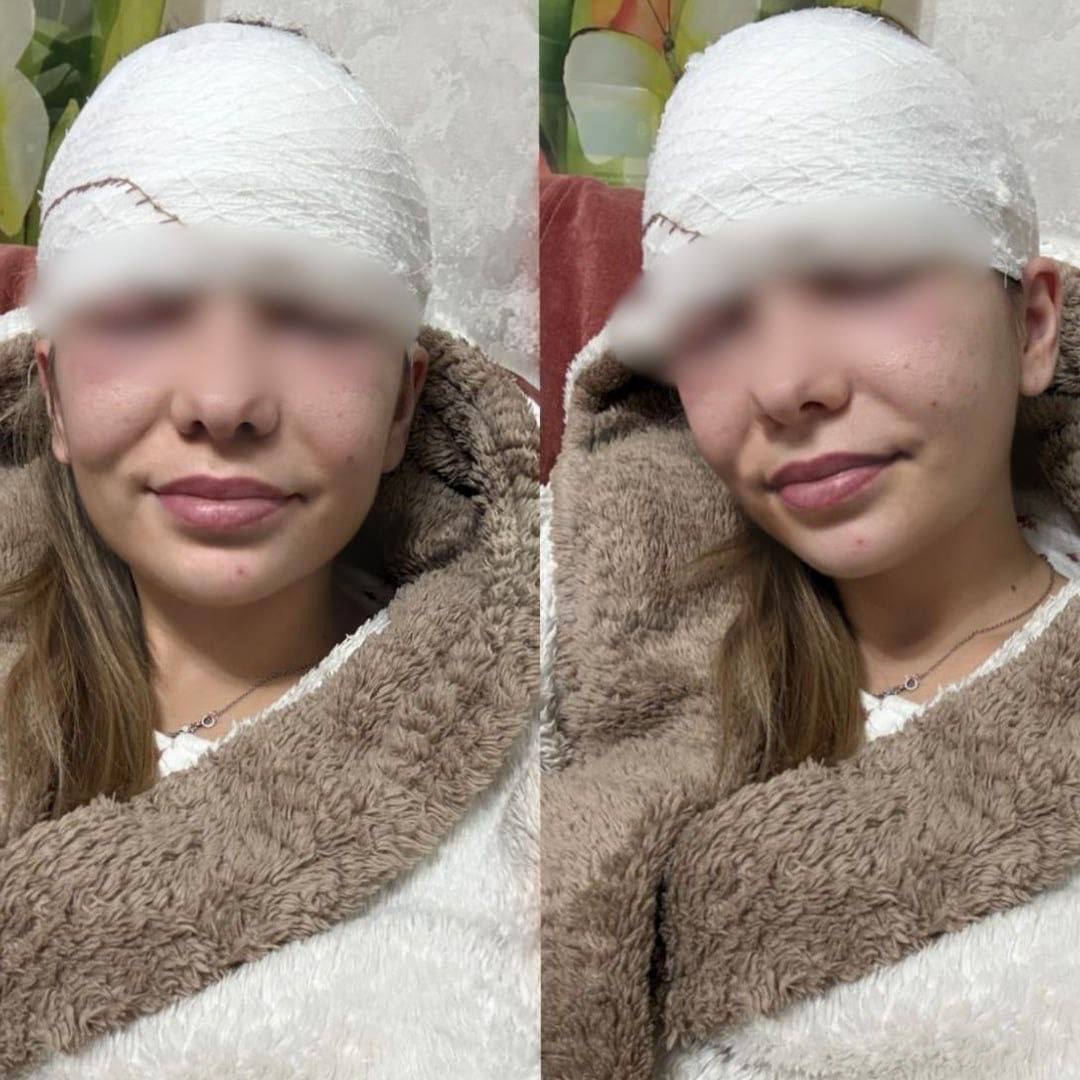 Россиянке разрезали лоб из за выдавленного прыща 28 летняя жительница Архангельской области выдавила прыщ на лбу Уже на следующий день место опухло а спустя несколько дней отёк пошёл на всё лицо пишет Shot Сначала в больнице посоветовали просто заклеить ранку пластырем но вскоре девушку срочно госпитализировали Врачи разрезали лоб удалили гной и назначили антибиотики Позже выяснилось что воспаление началось из за грязных рук Делаем выводы Подписаться на Москва 24 Наши каналы Новости в MAX