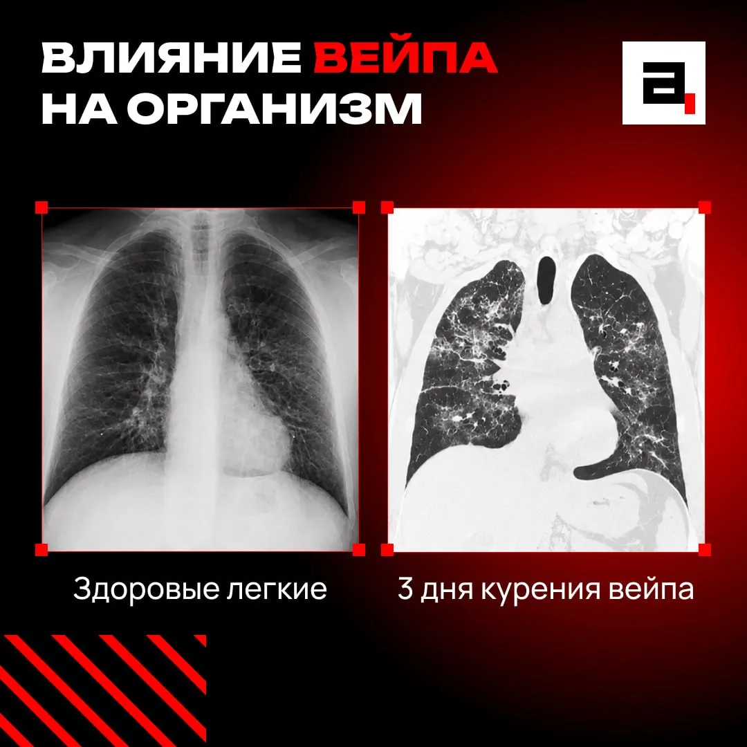 Вейп сжег легкие 19 летнего парня Пять лет он парил электронки а потом загремел в больницу с дикой одышкой и давлением 175 95 Балаковские медики провели КТ и ужаснулись легкие внутри были изуродованы рубцами Они больше никогда не будут работать как прежде Неудивительно что вейпы собираются запретить   Подпишитесь на Абзац в Максе
