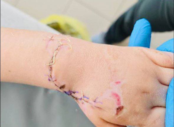 Ксения Собчак похвалила приморских врачей Российская журналистка и ведущая Ксения Собчак заявила что гордится врачами которым удалось спасти руку четырехлетней девочки пострадавшей на эскалаторе торгового центра в ЗАТО Фокино   Медики Владивостокской клинической больницы 2 провели интенсивное лечение включавшее хирургические обработки и пластику ран После месячного курса ребенок может двигать пальцами Накануне Нового года малышку выписали домой Горжусь нашими врачами невероятно так прокомментировала Ксения Собчак в своем ТГ канале Кровавая барыня 18 сообщение краевого Минздрава об успешном лечении  Напомним несчастный случай произошел 27 ноября в торговом центре ЗАТО Фокино Четырехлетняя девочка попала под ступени эскалатора машина затянула ее руку Ребенка экстренно доставили в Находкинскую городскую больницу где врачи оказали первичную хирургическую помощь и подготовили к транспортировке в краевую столицу Фото Предоставлено Владивостокской клинической больницей 2   NakhodkaMedia Прислать новость