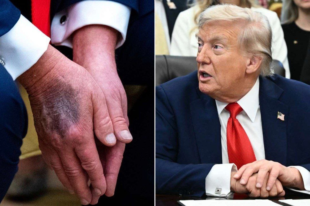 Западные таблоиды обсуждают что президент США Дональд Трамп пропал с радаров и не появляется на публике с прошлого вторника Припоминают что ранее у Трамп на руках видели характерные синяки как у королевы Елизаветы перед смертью и в целом строят конспирологические версии по поводу состояния его здоровья и даже возможной смерти Да и сам Трамп в начале августа намекал что дела его не очень и что он уже находится у подножия тотемного столба Волнуемся за него Не волнуемся за него