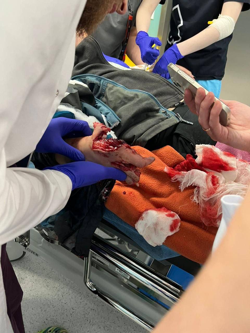 Фото 18  В Красногорске ребёнок подорвался на взрывном устройстве подняв на улице сверток денег 9 летний Глеб шёл по улице и наткнулся на свернутую пачку купюр Когда мальчик поднял и развернул её произошёл взрыв В результате ребёнку оторвало несколько пальцев на руке его госпитализировали