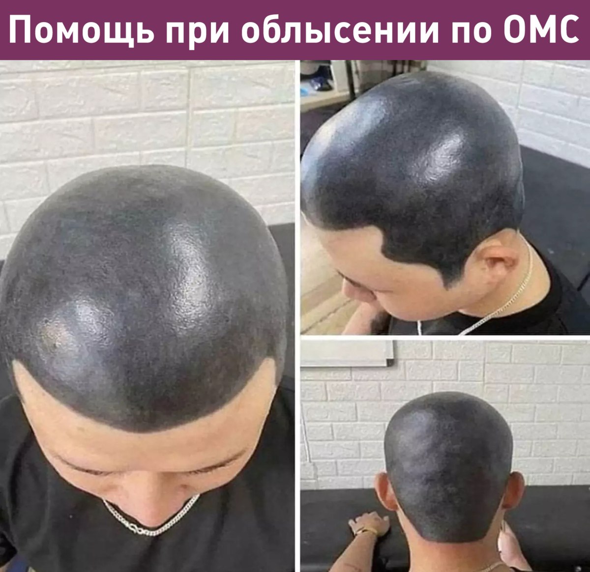 Президент Южной Кореи призвал к введению государственной медицинской страховки от выпадения волос The Guardian Он заявил что это не просто косметическая проблема а вопрос выживания А что ещё случилось