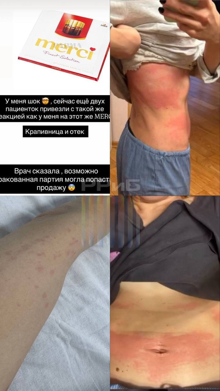 Москвичи попадают в больницы из за конфет Merci Минимум трое человек сейчас лежат в палатах с высыпаниями Одна из пострадавших решила перекусить шоколадом во время антракта в театре По словам девушки после этого её тело стало сильно чесаться и она покрылась огромными пятнами Пришлось вызвать скорую У пациентки диагностировали крапивницу и отёк По её версии шоколад мог оказаться бракованным retailrus