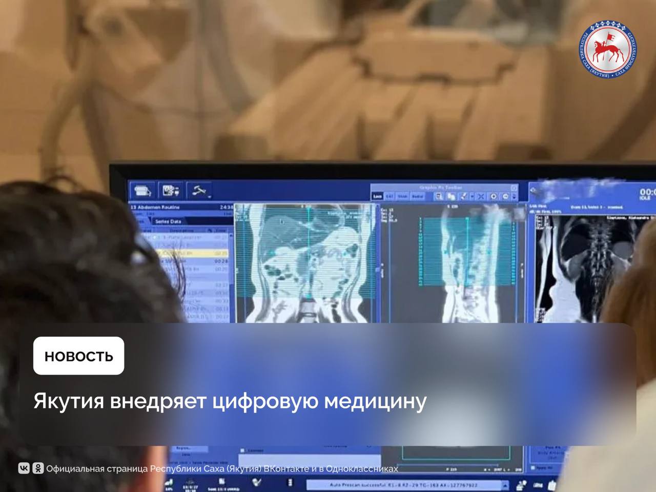 В Якутии в сфере медицины активно применяются технологии с искусственным интеллектом. Они помогают врачам в двух ключевых направлениях: анализ данных пациентов и обработка медицинских изображений. Система поддержки врачебных решений Webiomed уже работает в 55 медучреждениях республики. Она автоматически анализирует медицинские карты пациентов, выявляет скрытые болезни, предсказывает возможные осложнения и подсказывает, как снизить риски. Это помогает снизить количество врачебных ошибок, а врачам — сосредоточиться на живом общении с пациентом. Интерес к системе растёт: за 5 месяцев 2025 года количество обращений к ней почти сравнялось с цифрами за весь 2024 год. Второе направление — интерпретация снимков с помощью Искусственного интеллекта. В республике применяются решения Sciberia Lungs и платформа МосМедИИ. Они распознают патологии на КТ, маммографии, флюорографии и рентгене, обрабатывая снимки за 15 минут. Уже подключено 23 учреждения, к концу года их будет 67. Из 15 тысяч обработанных изображений почти треть показали наличие заболеваний.