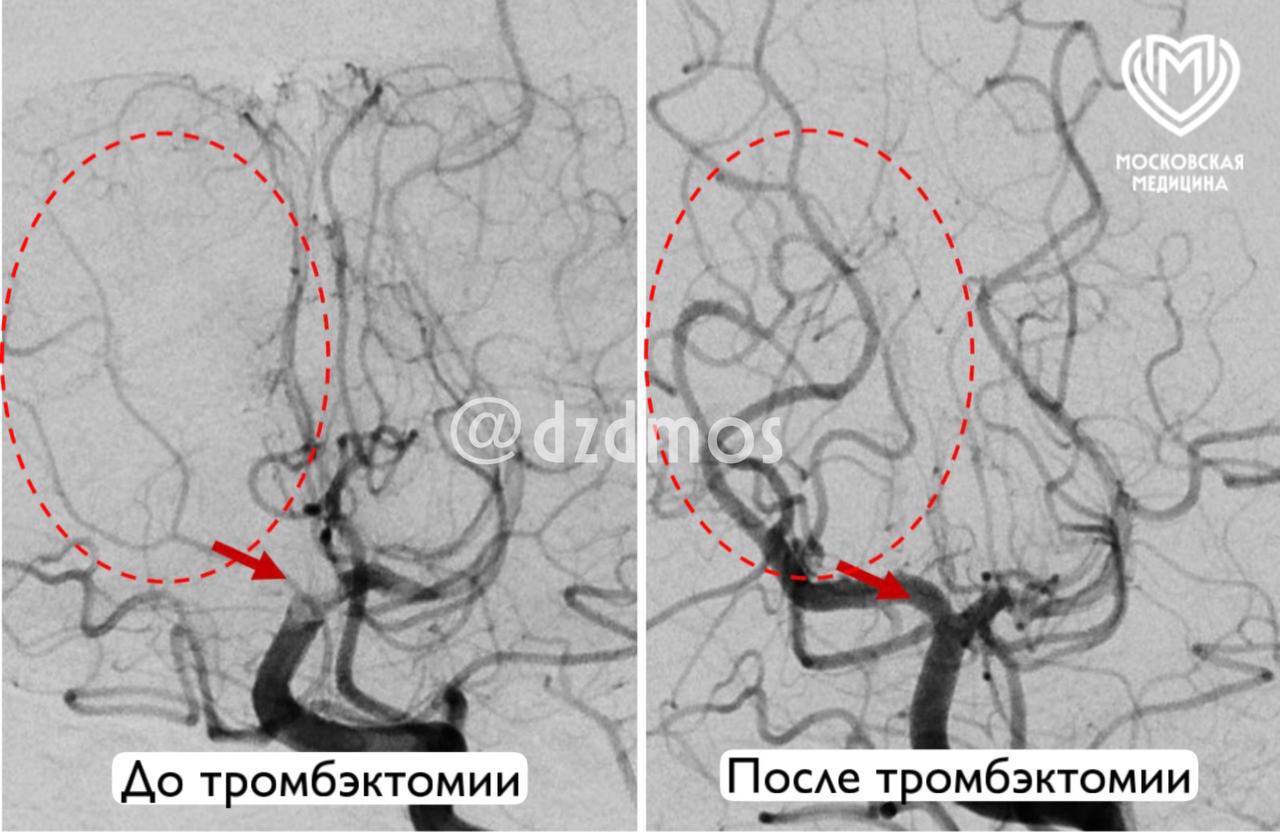 Инсульт в 21 год Да именно с таким диагнозом поступил в больницу Вересаева московский студент Обследование показало страшную картину крупный тромб перекрыл одну из важнейших артерий угрожая спровоцировать масштабный инсульт и оставить молодого парня парализованным навсегда Коварство болезни усугублялось наличием ряда серьезных сопутствующих заболеваний включая аневризму подключичной артерии и проблемы с кровоснабжением руки Любое промедление грозило необратимым повреждением мозга Медики решили применить тромбоэкстракцию единственный метод восстановления кровотока в такой ситуации Через крошечный прокол на ноге врачам удалось удалить злополучный тромб и восстановить кровоток Результат превзошел ожидания спустя всего четыре часа мужчина начал возвращаться к нормальному состоянию а через семь дней ушел домой абсолютно здоровым человеком Эта история стала ярким примером профессионализма медиков и доказательством того насколько важна каждая минута при инсульте Московская медицина Подписаться на Москва 24 Наши каналы Новости в MAX