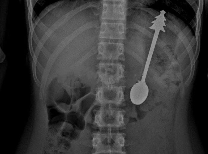 Ребенок случайно проглотил 14 сантиметровую ложку в Оренбурге Его срочно доставили в больницу где провели операцию по удалению столового прибора с елочкой на ручке Все прошло успешно и уже на следующий день ребенка отпустили домой сообщили в местном минздраве Подписаться на РИА Новости