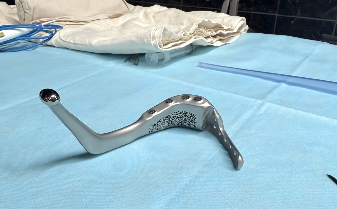 Донские хирурги имплантировали женщине новую челюсть взамен разрушенной онкологией Медики реконструировали фрагмент используя титановый имплант с готовыми гнездами для протезирования зубов Ранее такие методы практиковались лишь в федеральном центре Радикальное вмешательство по удалению опухоли потребовало вторым этапом настолько обширной реконструкции челюсти что стандартные методики замещения дефекта собственными тканями пациента исключались пишет источник Восстановление женщины прошло спокойно Врачи не только сохранили конфигурацию костей но и вернули пациентке способность жевать Фото РОБК ИА ДОН 24 Отправить новость MAX