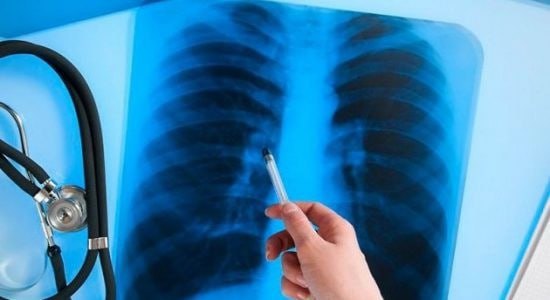 Флюорография спасает жизни половину случаев туберкулёза выявляют на ранней стадии В Приднестровье около 50 60 больных туберкулёзом обнаруживают именно во время ежегодной профилактической флюорографии когда симптомы ещё отсутствуют рассказала министр здравоохранения ПМР Кристина Албул Раннее выявление позволяет быстрее и эффективнее бороться с болезнью в отличие от Европы где флюорографию применяют только для групп риска Для охвата всей республики закупают флюорографические автобусы которые объезжают города и районы а также проводят обследования в селах tv pmr