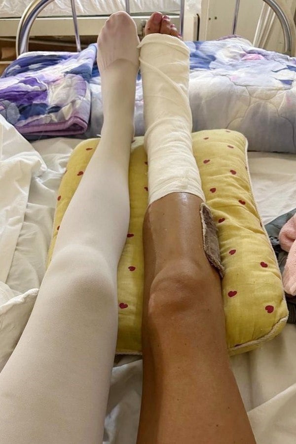 Красноярка упала с байка в Таиланде и попала под цементовоз Красноярка во время отпуска в Таиланде попала в аварию на мотобайке и сломала ногу. Историей пациентки поделились в группе краевой больницы в честь Всемирного дня врача-травматолога, прошедшего 20 мая. В начале года девушка упала с мотобайка, после чего по ее ноге проехал цементовоз. Врачи диагностировали 12 переломов, вывих и большую открытую рану. Помимо прочего, красноярке потребовалась пересадка кожи. Первую помощь оказали тайские врачи. Девушка отмечает, что ногу собирали буквально по частям, а большой пласт кожи удалось восстановить. Позже пациентку перевезли в краевую больницу. В Красноярске ей вправили вывих и провели аутодермопластику. «Теперь у меня есть две прекрасные ноги. И пусть одна из них выглядит пока не так, как раньше, но я продолжаю ежедневный труд под названием реабилитация. Уже почти три месяца я живу полноценной жизнью, хожу 8 тысяч шагов ежедневно без каких-либо вспомогательных средств и хромоты, вожу автомобиль и планирую к лету надеть любимые каблуки», — поделилась своим нынешним состоянием красноярка. Newslab