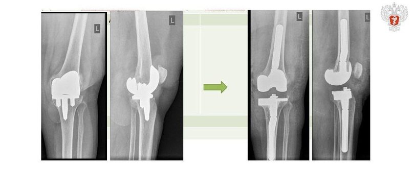 Минздрав России  VK   Врачи НМИЦ травматологии и ортопедии имени Г.А. Илизарова Минздрава России провели сложнейшие операции на суставах  В отличие от первичного эндопротезирования, ревизионные случаи более сложные. Это связано с рубцовыми изменениями мягких тканей, костными дефектами.  — Для успешного ревизионного протезирования необходим соответствующий опыт хирурга, наличие широкого спектра имплантатов и специального инструментария, — рассказал руководитель Клиники реконструктивно-восстановительной хирургии крупных суставов НМИЦ Николай Чирков.    Пациент из Забайкальского края проходил с искусственным тазобедренным суставом 8 лет. Затем резко появился болевой синдром.  Обследование показало износ и разрушение компонентов эндопротеза.  — Для замены компонентов в бедренной кости пациента проделали отверстие, через которое извлекли разрушенный компонент, а затем имплантировали необходимый удлиненный эндопротез, — пояснил Николай Чирков.    Вторая пациентка проходила с эндопротезом коленного сустава 13 лет. Нарастающие боли заставили женщину обратиться за помощью в НМИЦ.  ⏩ Разрушенные компоненты эндопротеза специалисты удалили, а на их место имплантировали ревизионные, заместили костные дефекты.  — Помимо того, что мы располагаем всеми необходимыми медизделиями и инструментарием, у нас есть собственный костный банк, обеспечивающий хирургов необходимым костнозамещающим материалом для пластики костных дефектов. Кроме того, мы начинаем работать с 3D индивидуальными конструкциями, — рассказал заместитель главного врача НМИЦ Андрей Каминский.  #МинздравНапоминает: пациентам важно ежегодно проходить рентгенологическое обследование имплантированного эндопротеза. Чем раньше выявится проблема, тем легче технически выполнить ревизию и получить хороший результат.