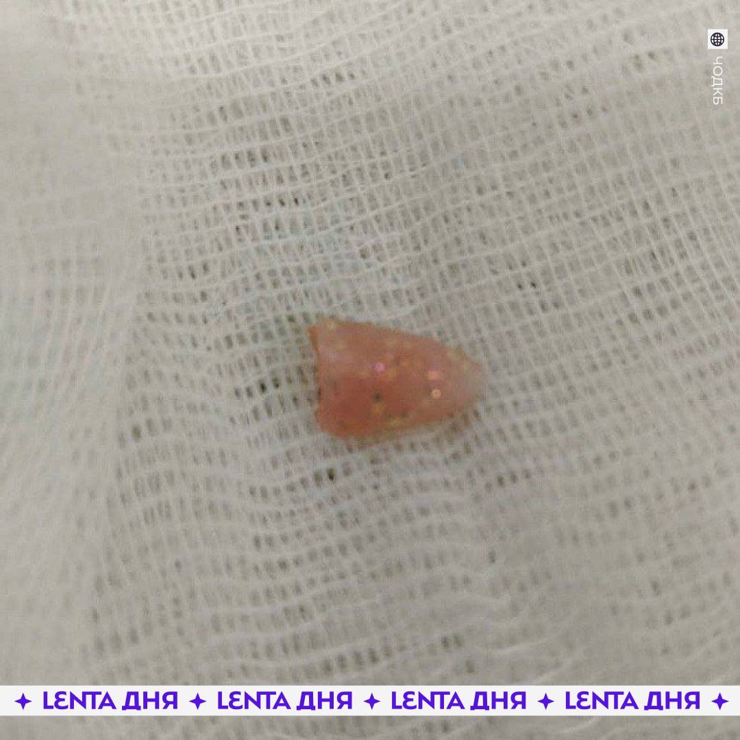 Младенец чуть не задохнулся из за маникюра матери Десятимесячный ребёнок поступил в челябинскую больницу с затруднённым дыханием и хрипами Мать утверждала что он мог подавиться собачьим кормом Медики обнаружили инородный предмет почти полностью перекрывший просвет глотки воздух проходил только через узкую щель Во время экстренной ригидной бронхоскопии врачи извлекли наращённый ноготь Ребёнок провёл ночь в реанимации сейчас переведён в обычную палату и идёт на поправку плюс фобия у мамочек Подпишись на Ленту дня MAX ТГ Участвуй в розыгрыше