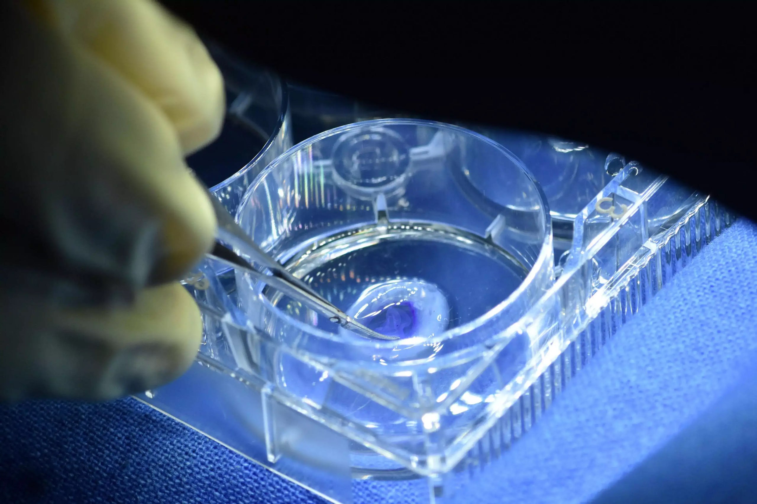 Израильские хирурги впервые в мире вернули зрение слепому пересадив распечатанную на 3D принтере роговицу глаза Имплант вырастили с нуля в специальной биоустановке используя человеческие клетки умершего донора В результате искусственная роговица в точности повторила естественную структуру и прижилась без каких либо усложнений Говорят из клеток всего одной настоящей роговицы можно печатать по 300 таких имплантов что решает проблему нехватки донорских тканей