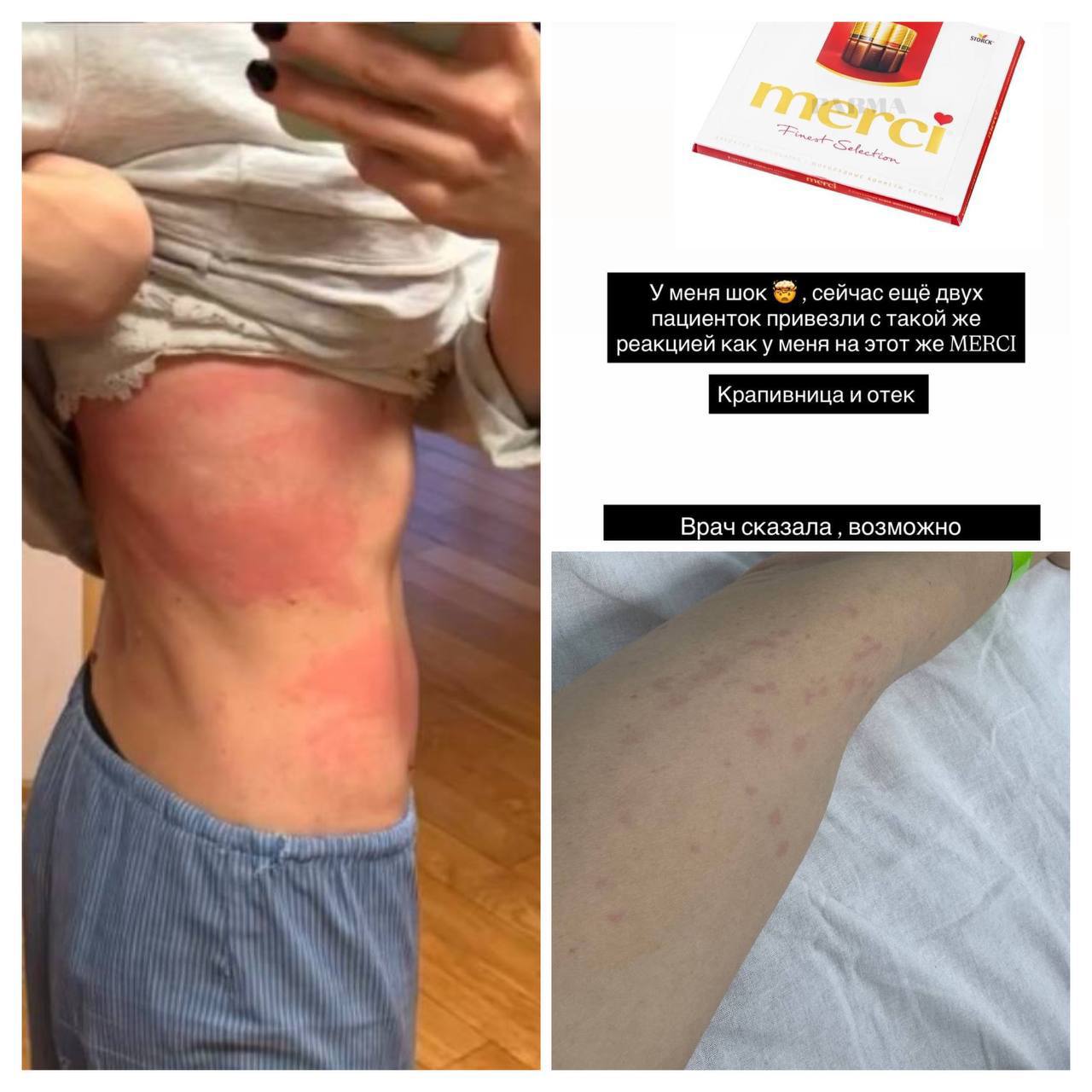 Шоколад Merci довёл москвичку до больницы После конфет у девушки резко начался сильный зуд а тело покрылось огромными пятнами С ней лежат ещё двое человек пострадавшие от этих конфет Девушка была в театре и во время антракта решила перекусить шоколадом После этого у неё начало чесаться всё тело Пришлось вызвать скорую На следующее утро москвичке стало ещё хуже её снова обсыпало Ей диагностировали крапивницу и отёк Она считает что шоколад мог быть бракованным так как от него высыпало ещё двух человек bankoffo