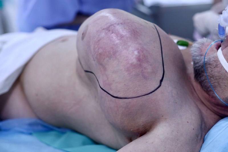 Огромную опухоль удалили мужчине в Обнинске Николаю поставили онкологический диагноз в 14 лет Тогда он прошел лечение хондросаркомы ребра злокачественной опухоли развивающейся из хрящевой ткани Спустя 38 лет болезнь вернулась Опухоль росла в течение двух лет достигнув гигантских размеров и мужчина обратился в МРНЦ имени А Ф Цыба Опухоль поразила практически всю левую половину грудной клетки разрушая ребра прорастая в легкое и перикард Специально для пациента при помощи 3D моделирования была создана индивидуальная титановая конструкция способная заместить пораженную опухолью часть грудной клетки рассказал завотделением торакальной онкологии МРНЦ Григорий Афонин Операция проходила в несколько этапов Врачи успешно удалили опухоль и прямо в канун Нового года пациента выписали Подписаться Прислать новость