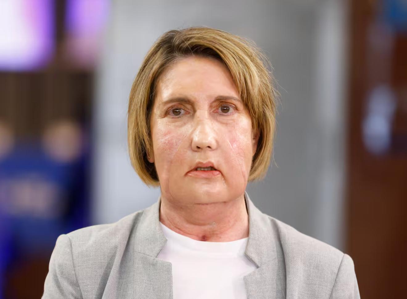 В Барселоне провели первую в мире пересадку лица от донора умершего после эвтаназии В госпитале Vall d Hebron прошла многочасовая операция в ходе которой женщине было пересажено лицо от донора получившего эвтаназию по программе Prestación de ayuda para morir Pram Пациентка перенесла тяжёлую инфекцию из за которой утратила способность говорить и есть но после пересадки сможет вести нормальную жизнь В операции и подготовке к ней участвовали около ста специалистов и использовались 3D технологии Фото EFE