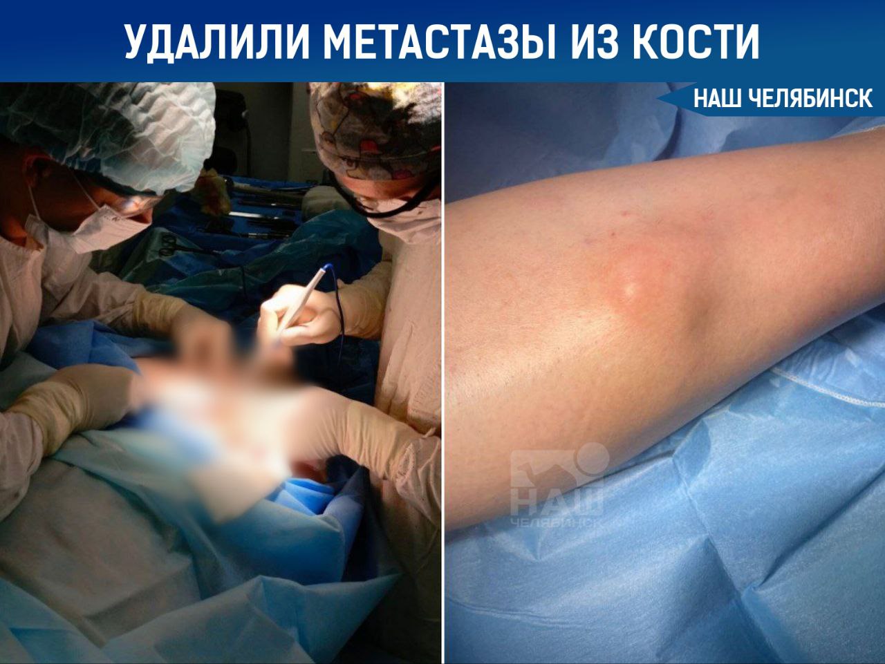 Челябинские онкологи начали удалять опухоли с метастазами в кости В областном центре онкологии и ядерной медицины провели сложную операцию по удалению опухоли мягких тканей голени с прорастанием в кость Ранее таких пациентов направляли на лечение в клиники Москвы и Санкт Петербурга Пациенткой стала 72 летняя женщина Врачи удалили опухоль и поражённый участок кости а дефект восстановили с помощью трансплантата взятого из другой кости Пенсионерка уже самостоятельно передвигается обследования не выявили признаков рецидива или прогрессирования заболевания Наш Челябинск только самое важное про город Подпишись