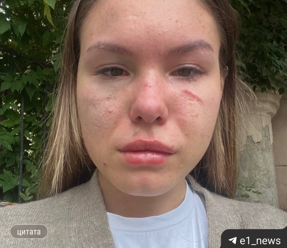 18 Мама в декрете получила сотрясение мозга после драки в министерстве образования 27 августа Полина пришла перевести ребенка в другой детский сад У неё возник конфликт с посетительницей которая была с двумя детьми из за очереди пишет Е1 По словам Полины после словесной перепалки агрессорша схватила её за волосы повалила на пол и била головой о плитку Женщине диагностировали закрытую черепно мозговую травму сотрясение мозга и гематомы Полиция проводит проверку Подписаться Прислать новость