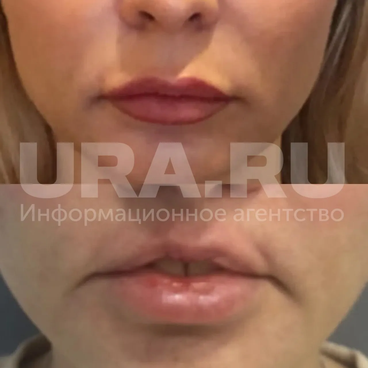 Губы не смыкались еда вываливалась чем закончился поход екатеринбурженки к пластическому хирургу В апреле 2024 года в клинике Клуб красоты 42 летней Марине сделали операцию Булхорн по коррекции верхней губы Однако хирург отсек почти вдвое больше тканей чем планировалось 7 мм вместо 4 и повредил структуру носа В результате у женщины появились проблемы с дыханием и речью Екатеринбурженка потеряла работу рассталась с мужем и проходила лечение у психиатра ведь лицо в зеркале вызывало у нее чувство отвращения и стыда Клиника свою вину не признавала однако суд назвал оказанную услугу некачественной и постановил взыскать с Клуба красоты более 1 5 млн рублей включая 1 млн компенсации морального вреда Ответчик с решением не согласен и намерен обжаловать его Подписаться на URA RU мы в MAКС