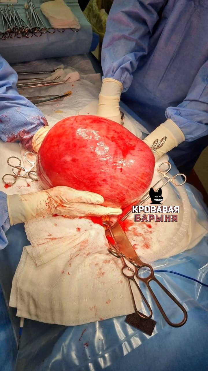Миому матки весом с годовалого ребёнка удалили врачи 60 летней женщине во Владивостоке Медики которым не страшно доверить жизнь Женщина несколько лет терпела тянущие боли внизу живота ощущение давления и проблемы с мочеиспусканием однако за медицинской помощью не обращалась Со временем появились отёки чувство неполного опорожнения мочевого пузыря и затруднённое дыхание Врачи понадобились только тогда когда боль стала невыносимой пациентка вызвала скорую помощь сообщили Осторожно Media в минздраве Приморья В Тысячекоечной больнице УЗИ показало миому матки размером больше 30 недель беременности Женщину экстренно госпитализировали и прооперировали Во время сложного вмешательства осложнённого сдавлением внутренних органов врачи удалили опухоль весом 15 килограммов Этот случай очень показателен Образование таких размеров не вырастает за месяц или год Это результат многолетнего невнимания к своему организму прокомментировал заведующий гинекологическим отделением Эдуард Зиганшин Операция прошла успешно пациентка быстро пошла на восстановление Медики отмечают что при своевременном обращении к врачу подобных осложнений можно было бы избежать Врачи также напомнили о важности регулярных осмотров у гинеколога и диспансеризации даже при отсутствии выраженных симптомов